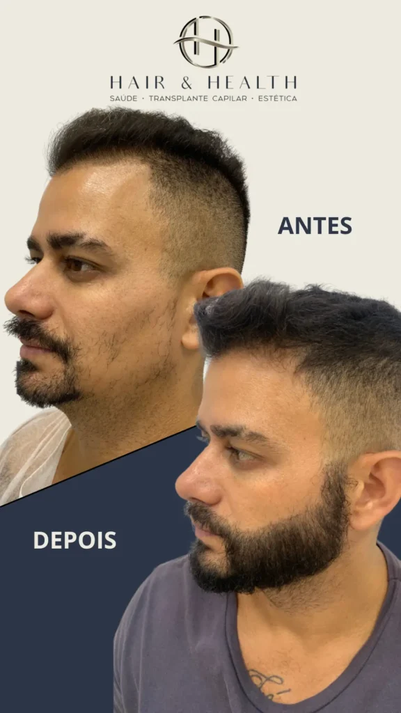 Antes e Depois Edgar Barba