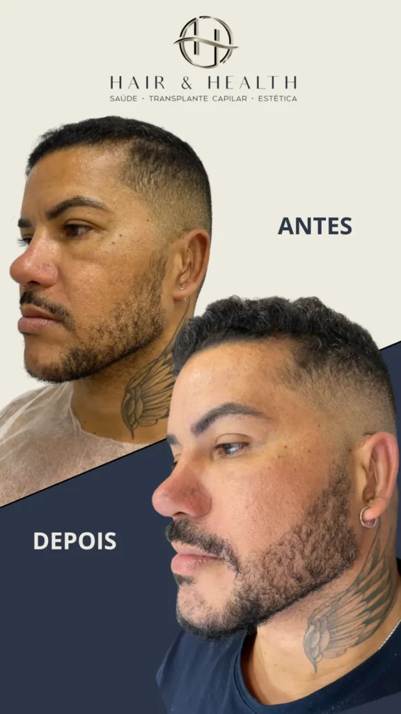 Antes e Depois Jackson Barba